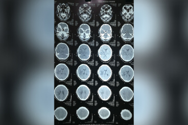 Brain tumor surgeon in Aurangabad
